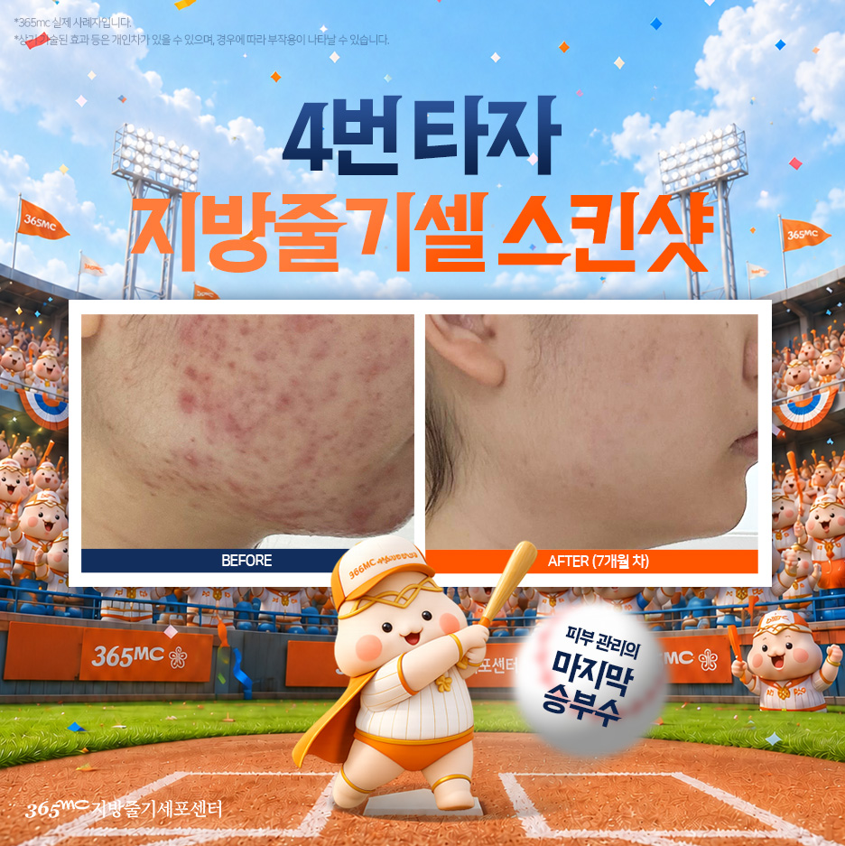 지방줄기세포 시술, 정확히 뭘 하는 걸까 관련 안내 이미지